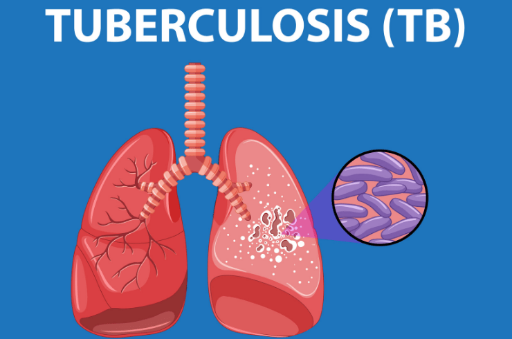 Tuberculosis (TB) Treatment